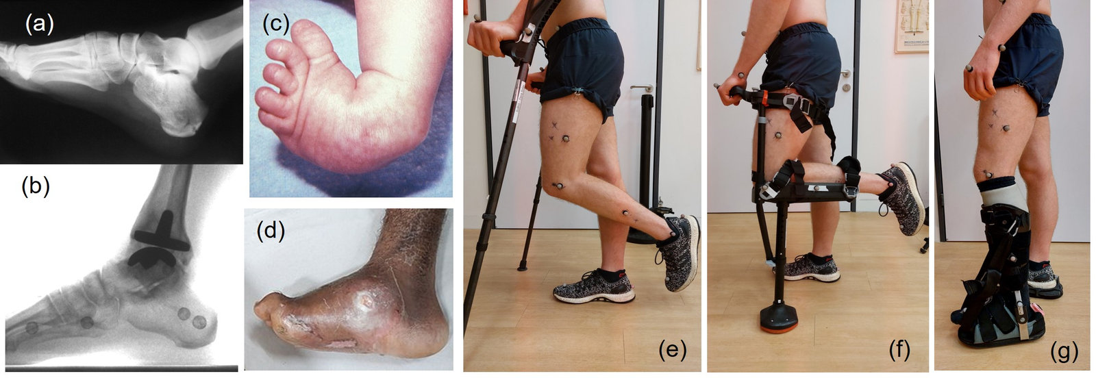 Medical conditions requiring ankle-foot offloading and the devices studied